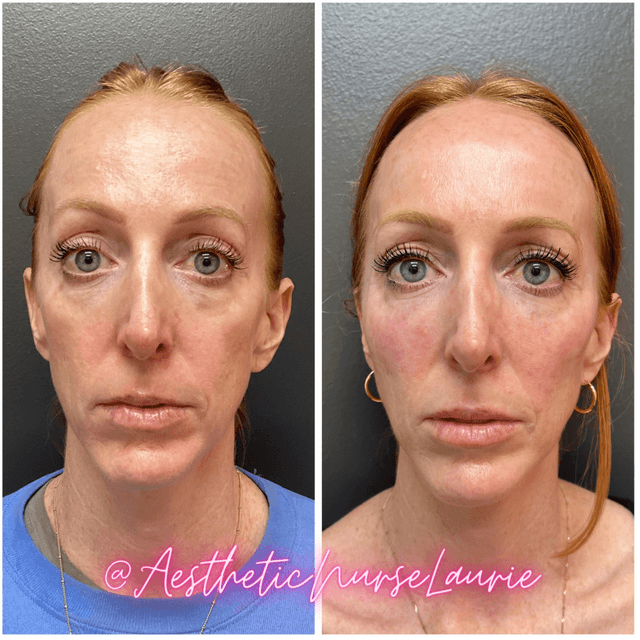 Full face rejuvenation and tear trough correction Carlsbad.
