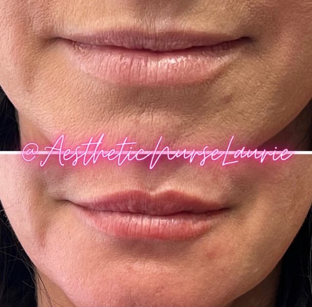 Lip filler injection before and after