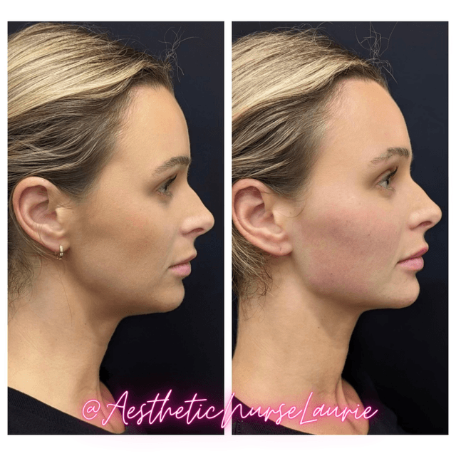 Jawline contouring and profile balancing Carlsbad.