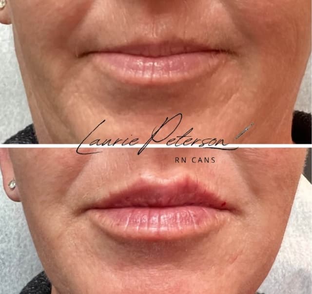 Laurie Peterson natural looking lip filler botox before and after