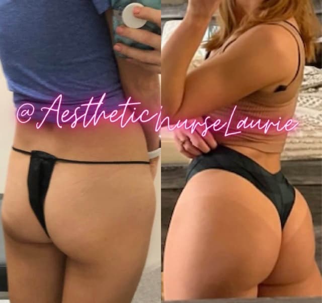 Laurie+Peterson+no+surgery+Brazilian+butt+lift+before+and+after+results