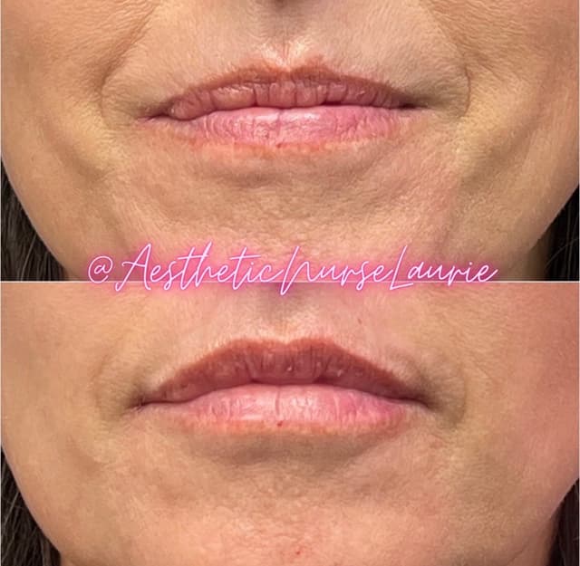 Lip filler for hydration and symmetry Carlsbad.