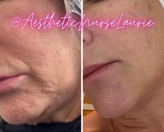 Non-surgical jowl lift and jawline contouring Carlsbad.