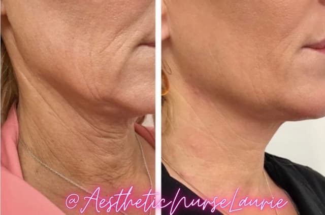 Hyperdilute Radiesse for neck skin tightening Carlsbad.
