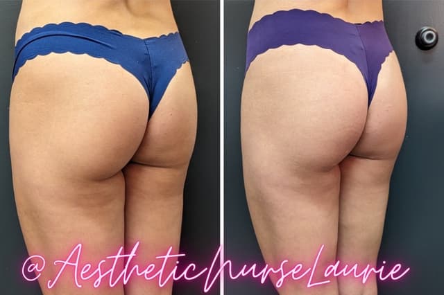 Sculptra non-surgical BBL and hip dip correction Carlsbad.